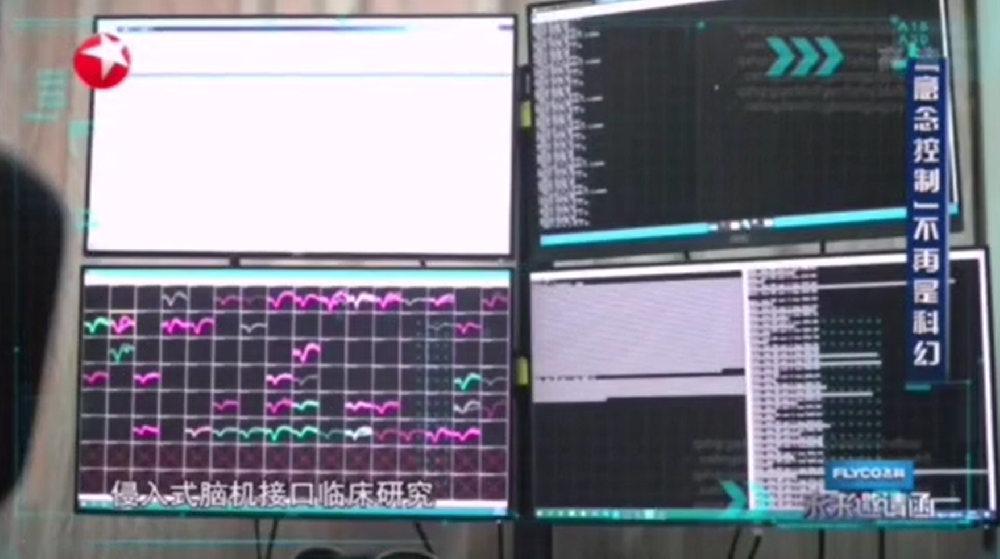 中国国内第一例侵入式脑机接口临床研究